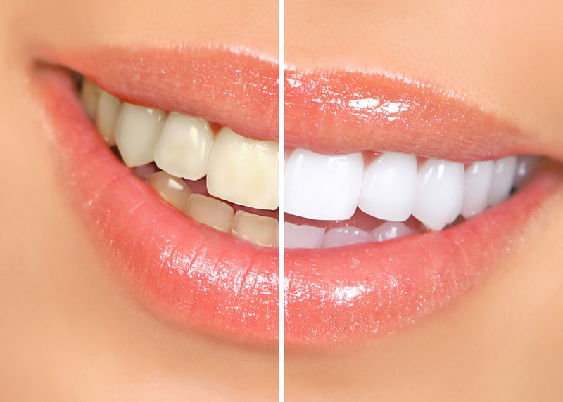 Teeth Whitening  Deale, MD 